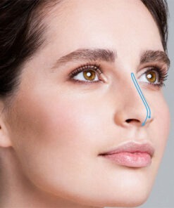 نخ آپتوس Sole Rhinoplasty Method